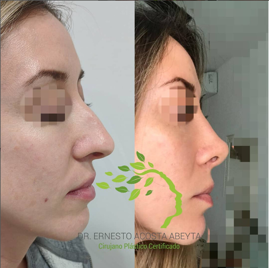 Before and After Result